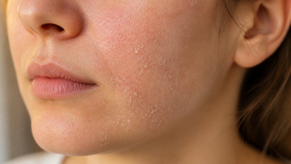 نمای نزدیک از گونه و بینی فردی با خشکی، قرمزی خفیف و پوسته های ریز پوست زیر نور طبیعی